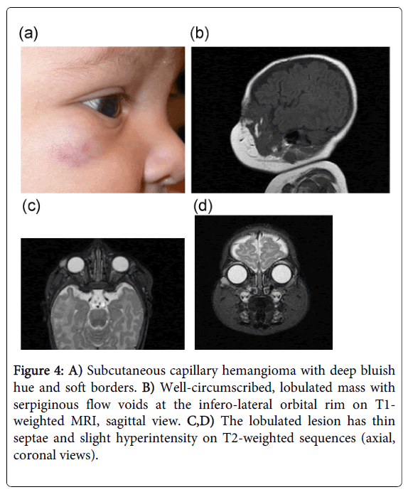 periorbital ecchymosis neuroblastoma