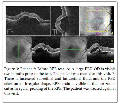 RPE Tear After Anti-VEGF Injection - Retina Image Bank