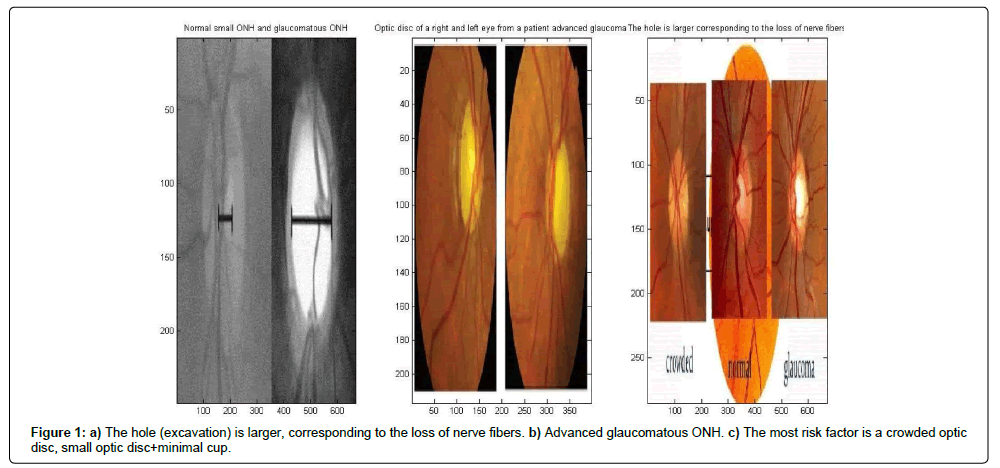 Study of the Contour and the Excavation of the Optic Nerve Head