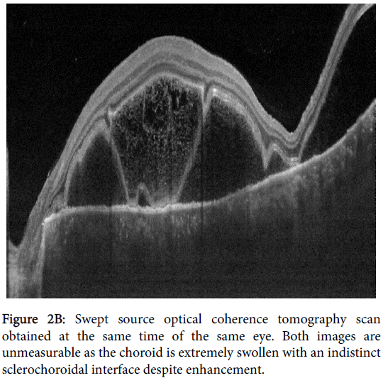 Comparison Of Enhanced Depth Imaging And Swept Source Optical Coh