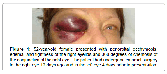 Black Eye (periorbital haematoma): Causes, Symptoms, Risk Factor