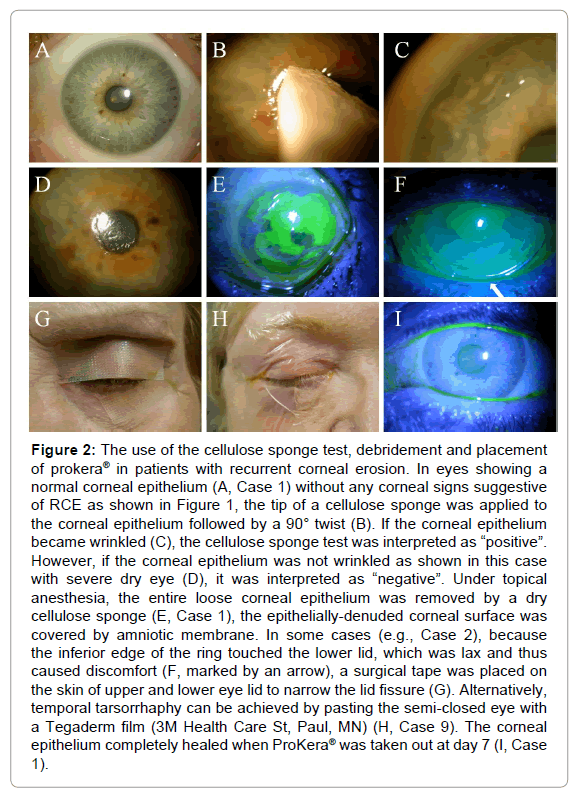 Self-retained Amniotic Membrane For Recurrent Corneal Erosion