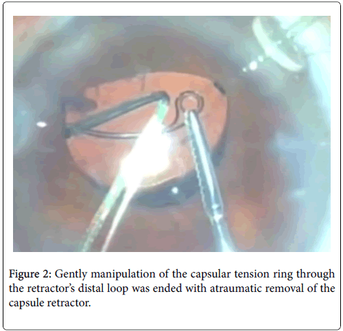 Intraocular lens and capsular tension ring in the fibrotic capsular bag |  Download Scientific Diagram