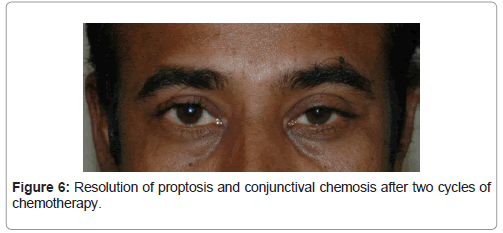 Multiple Myeloma Presenting as Unilateral Proptosis: A Case Repor