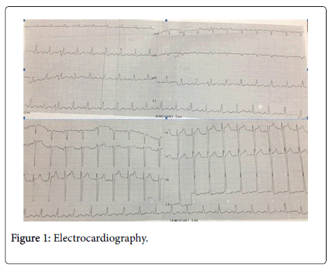 Dilated Cardiomyopathy in a Young Man with Illicit Cocaine Use: A