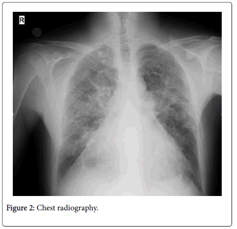 Dilated Cardiomyopathy in a Young Man with Illicit Cocaine Use: A