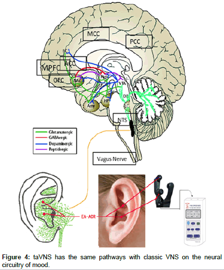 Vagal Nerve Stimulation for Depression and Anxiety