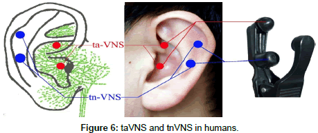 Transcutaneous auricular vagus nerve stimulation as a potential