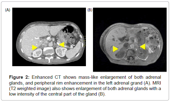 A Case of Primary Adrenal Tuberculosis - A Diagnostic Quandary