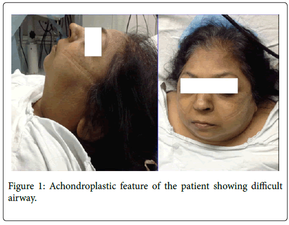 General Medicine Achondroplastic Feature