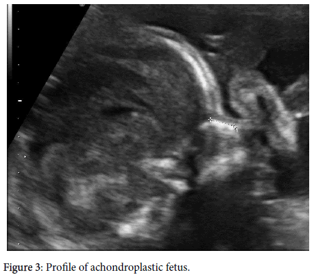 achondroplasia ultrasound
