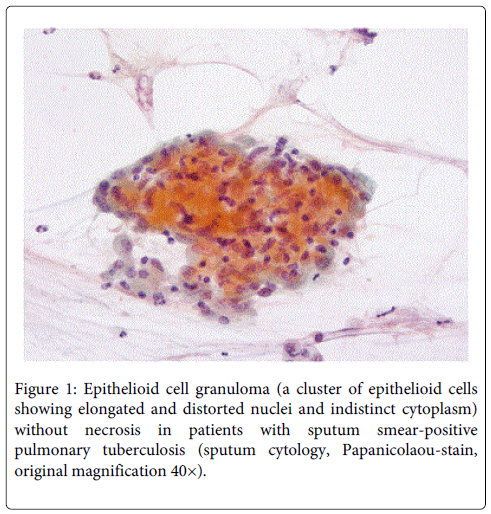 Mycobacterial-diseases-Epithelioid-cell