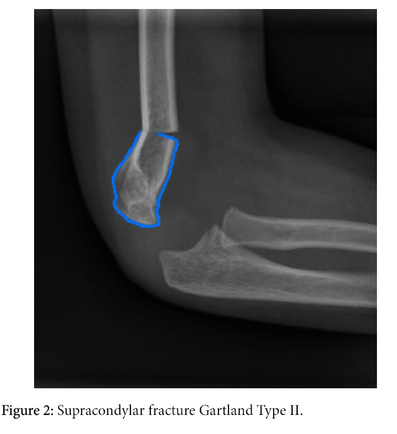 Orthopedic Muscular System Fracture